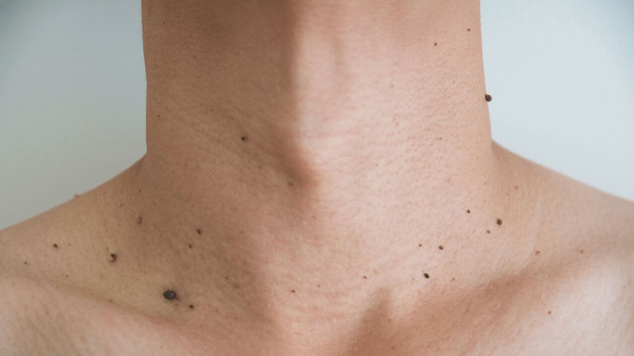 Keramin cream treatment for papillomas on the neck and chest