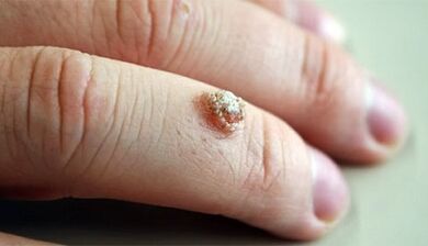 Methods for treating warts with Celandine