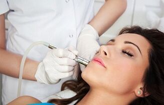 laser wart removal