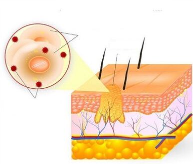 How does a wart grow