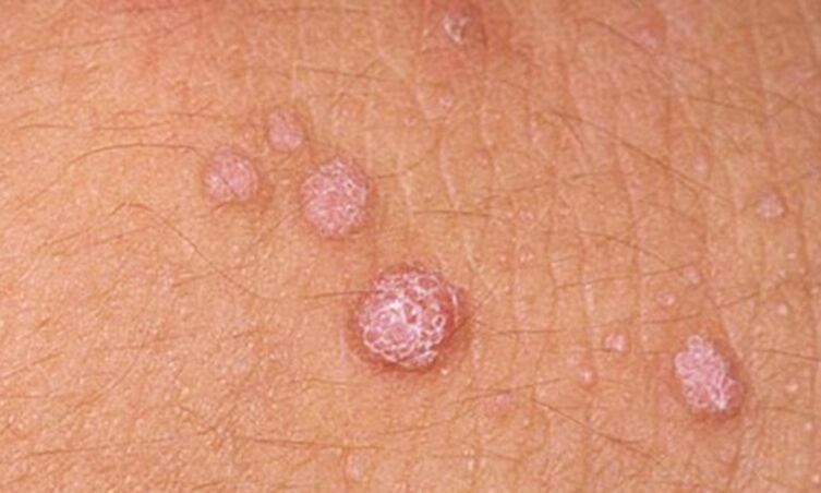 HPV causes the appearance of skin tags.