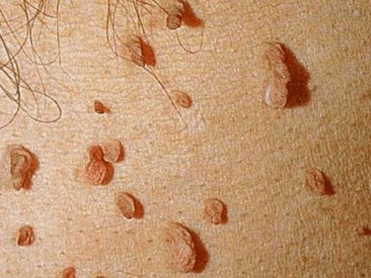 Papillomas on the body.