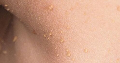 How does human papillomavirus manifest