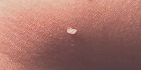 human papillomavirus in the skin
