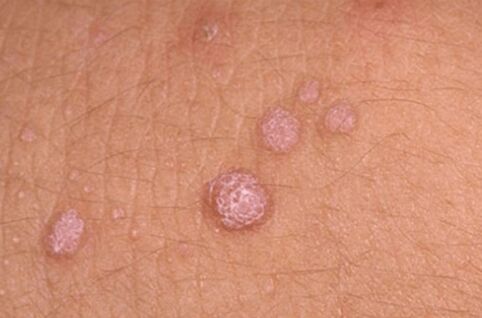 human papillomavirus symptoms