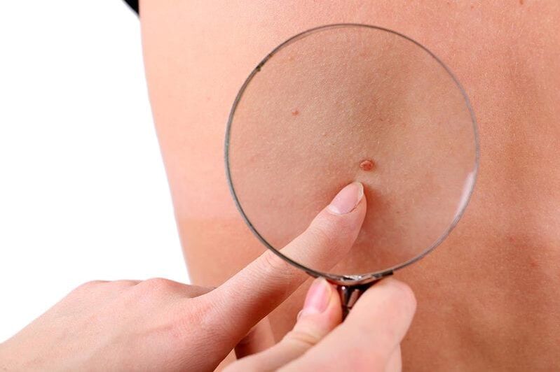 Papilloma under magnifying glass