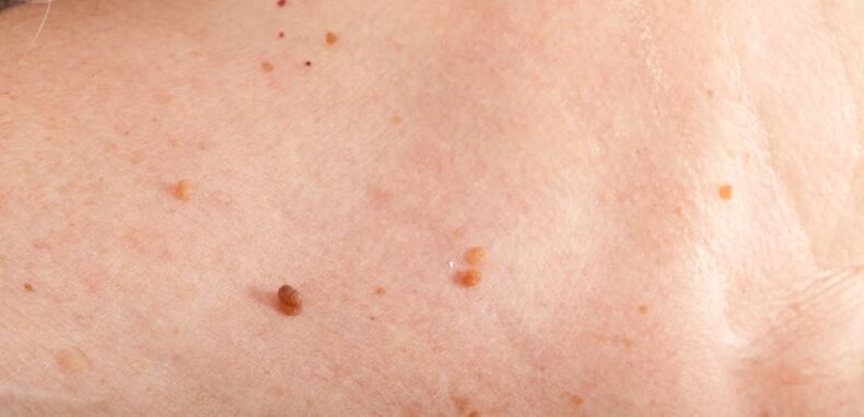 Papillomas on the body.