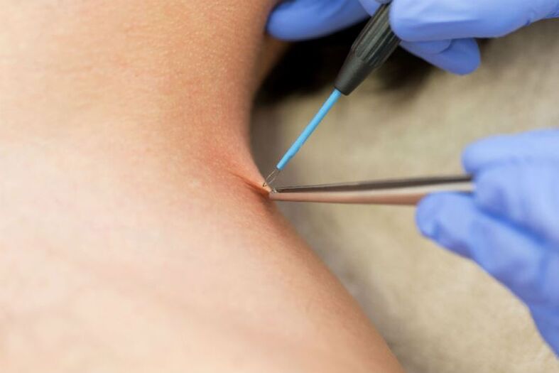 The procedure to remove the papilloma using electrocoagulation.