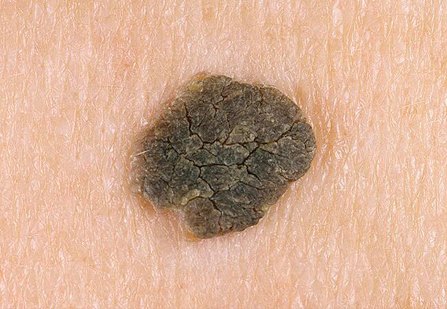 black wart on skin