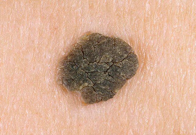 wart on the skin