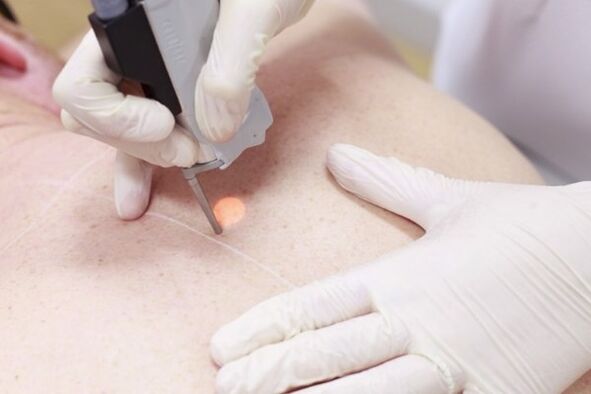 A popular method of removing papillomas with a laser. 