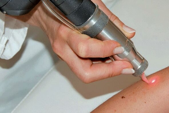 Laser removal of papilloma.