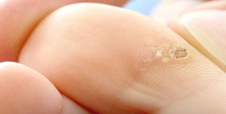 Spike in the toe