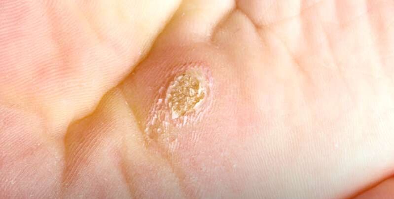 plantar wart (spinal wart)
