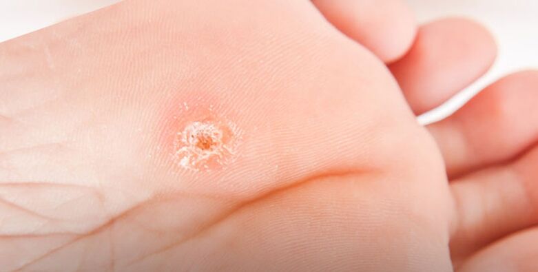 plantar wart on the foot