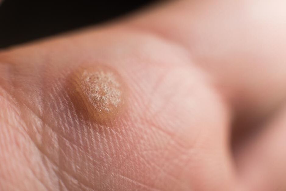 human papilloma virus on the skin