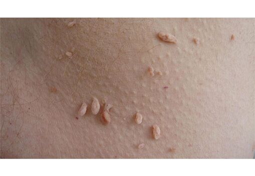 A sign of HPV infection is the appearance of papillomas on the body.
