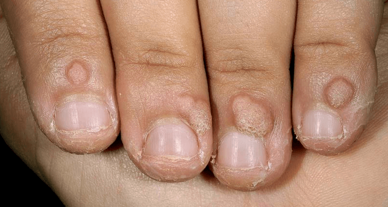 Warts